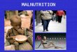 MALNUTRITION. Malnutrition When the body does not get the right amount of nutrients. The physical function of an individual is impaired to the point where