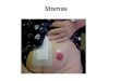Stomas. Ostomy: A surgical opening made into the bowel to allow for the elimination of stool. Stoma: The part of the bowel or urinary system visible on