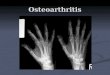 Osteoarthritis. Knee osteoarthritis Osteoarthritis