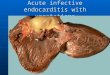 Acute infective endocarditis with vegetations. Ventricular Aneurysm complicating MI