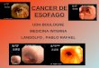 CANCER DE ESOFAGO UDH BOULOGNE MEDICINA INTERNA LANDOLFO, PABLO RAFAEL