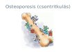 Osteoporosis (csontritkulás)