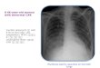 A 66-year-old woman with abnormal CXR