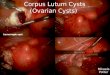 Corpus Lutum Cysts         (Ovarian Cysts)