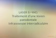 LASER Er-YAG: Traitement dâ€™une l©sion parodontale infraosseuse interradiculaire