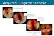 Acquired Subglottic Stenosis