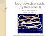 Neurocysticercosis ( cysticercosis )