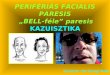 PERIFÉRIÁS FACIALIS PARESIS  „BELL-féle” paresis KAZUISZTIKA