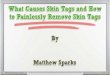 ppt 37796 What Causes Skin Tags and How to Painlessly Remove Skin Tags