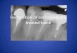 Restoration of  endodontically  treated tooth