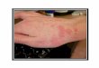 Scabies home treatment signs of scabies, picture of scabies