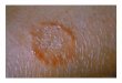 Ringworm in humans treatment