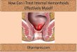 How Can I Treat Internal Hemorrhoids Effectively Myself