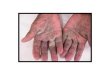 Treatment for scabies causes of scabies, scabies rash images