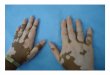 Etiology of vitiligo