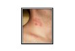 Scabies rash pictures over the counter scabies treatment, do i have scabies