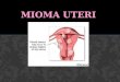 Mioma, Adenomiosis, Endometriosis, CA Endometrium