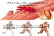 Afectiunile Sistemului Muscular