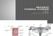 Refarat Kanker Vagina