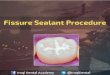 Fissure Sealant Procedure Explained