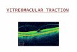 Vitreomacular traction
