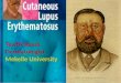 Cutaneous lupus erythematosus