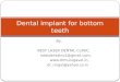 Dental implants for bottom teeth