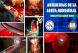 Aneurisma de la aorta abdominal. 2