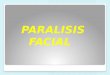 Presentacion paralisis facial
