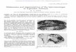 Melanoma and pigmentation of the leptomeninges