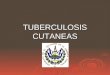 Tuberculosis cutaneas