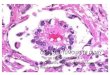 germ cell tumours of ovary