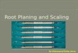 Root planing and scaling