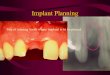Implant Planning Site of missing tooth where implant is to be placed