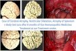 Case of Cerebral Atrophy, Ventricular Dilatation, Atrophy of Splenium, Body & Homoeopathy