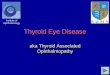 Thyroid Eye Disease - International Council of · PDF fileCauses • TED/TAO is an eye disease associated with disease of the thyroid gland • Most commonly, it occurs with an overactive