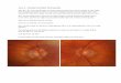 Case 6 Dysthyroid Optic Neuropathy - Introduction - Publicglaucomaeducation.com/assets/gpep/pdf/Case6_Case_and_Questions… · Case 6 – Dysthyroid Optic Neuropathy Mrs B, a 67 year