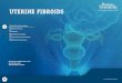 Uterine Fibroids Training - Boston · PDF fileSelect from these topics Uterine Fibroids Anatomy Standard Treatments Uterine Fibroid Embolization UFE Clinical Outcomes UTERINE FIROIDS