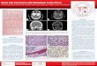 Renal Cell Carcinoma with Metastasis to the · PDF fileRenal Cell Carcinoma with Metastasis to the Clivus 1Amit A. Patel, MD; 1Arjuna B. Kuperan, MD; ... Yanagawa M, Kawamura J. A