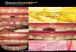 Restorative Implant Dentistry Program · PDF fileRestorative Implant Dentistry for the General Dentist 2017 Before After Herman Ostrow School of Dentistry of USC ... •Biomechanics