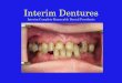 IMMEDIATE INTERIM DENTURES - University at are taken using record bases with wax rims Centric Relation - most retruded position Use non-pressurizing recording material Separate record