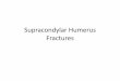 Supacondylar Humerus Fractures - Alpha Hand …alphahandcentre.com/.../2014/08/Supacondylar-Humerus-Fractures-.pdfTwo,Very,DifferentFracture,Types • Adultsupracondylar,(SC),humerus,fxs,