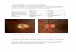 Case 2 - Right Optic Nerve Head Drusen (ONHD)glaucomaeducation.com/assets/gpep/pdf/Case2_Case_and_Questions… · The classic RNFL ‘double hump’ (RNFL thickest superiorly and