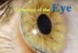 Pathology of the€¢ Optic Neuritis –Many causes, but demyelinating (Multiple Sclerosis) causes are most important • Papilledema – swelling due to increased intracranial pressure
