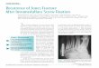 CASE REVIEW Recurrence of Jones Fracture After ... of Jones Fracture After Intramedullary Screw Fixation CASE REVIEW David Brown, ... fracture and stated that he knew his foot had