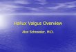 Hallux Valgus Overview - OrthoSurgery · Hallux Valgus Overview Alex Schroeder, M.D. ... Second toe amputation • Windlass mechanism disruption. Pathophysiology 