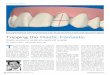 tripping the Plastic Fantastic - Orthodontics · Rotation sensation for laterals and cuspids with Invisalign By jonathan l. nicozisis, DMD, Ms tripping the Plastic Fantastic