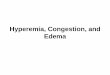 Hyperemia, Congestion, and Edema - University Of .Pitting edema. Trivial and life-threatening edema