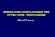 SEMIOLOGIE RADIOLOGIQUE DES AFFECTIONS andre.ar.free.fr/   Syndrome de comblement alv©olaire (ECN