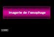 Imagerie de l’œsophage - Les cliniques radiologiques …onclepaul.net/wp-content/uploads/2011/07/oesohage-pathologie-tumor... · Oesophagite caustique Diverticules de Zenker: